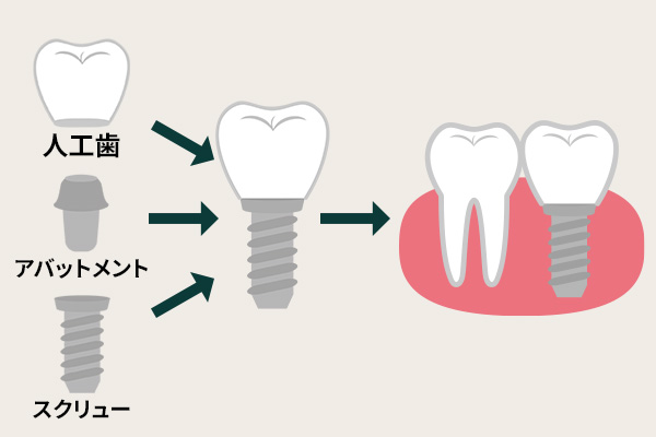 インプラント構造