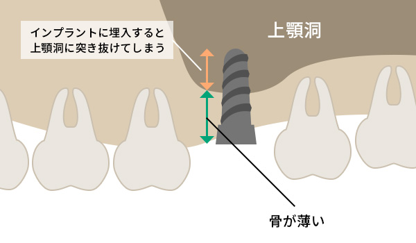 インプラントの上顎洞への突き抜け