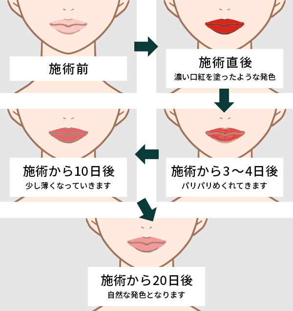 リップアートメイクの色_術後の変化